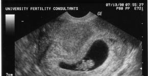 Kako izgleda fetus u 8. akušerskoj sedmici