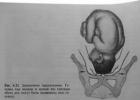 Fetal presentation at 28 weeks of gestation